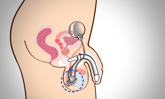 음낭부위에 위치한 펌프를 누르면 리저브에 있는 액체가 음경의 실린더로 이동합니다.
